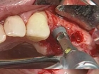 Dr Abid Faqir - Dental Implant Process, How is a Dental Implant Done